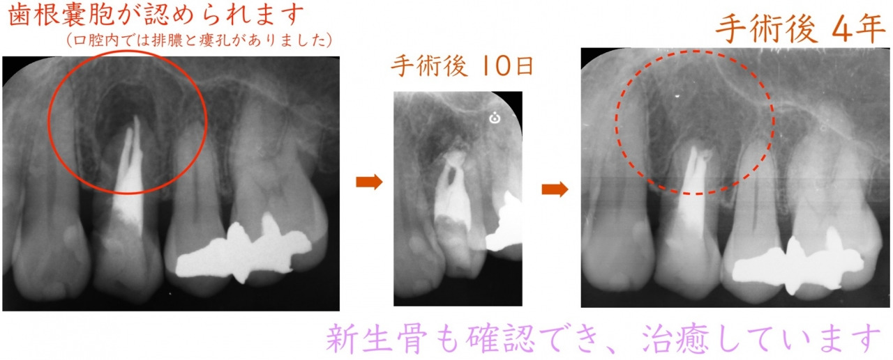 歯根嚢胞の術前・術後の画像