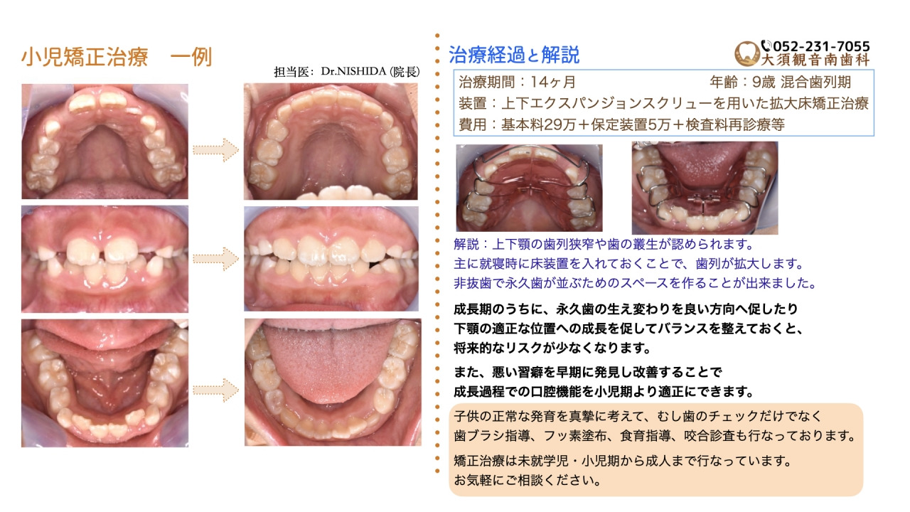 元サイト掲載の小児矯正治療の症例画像
