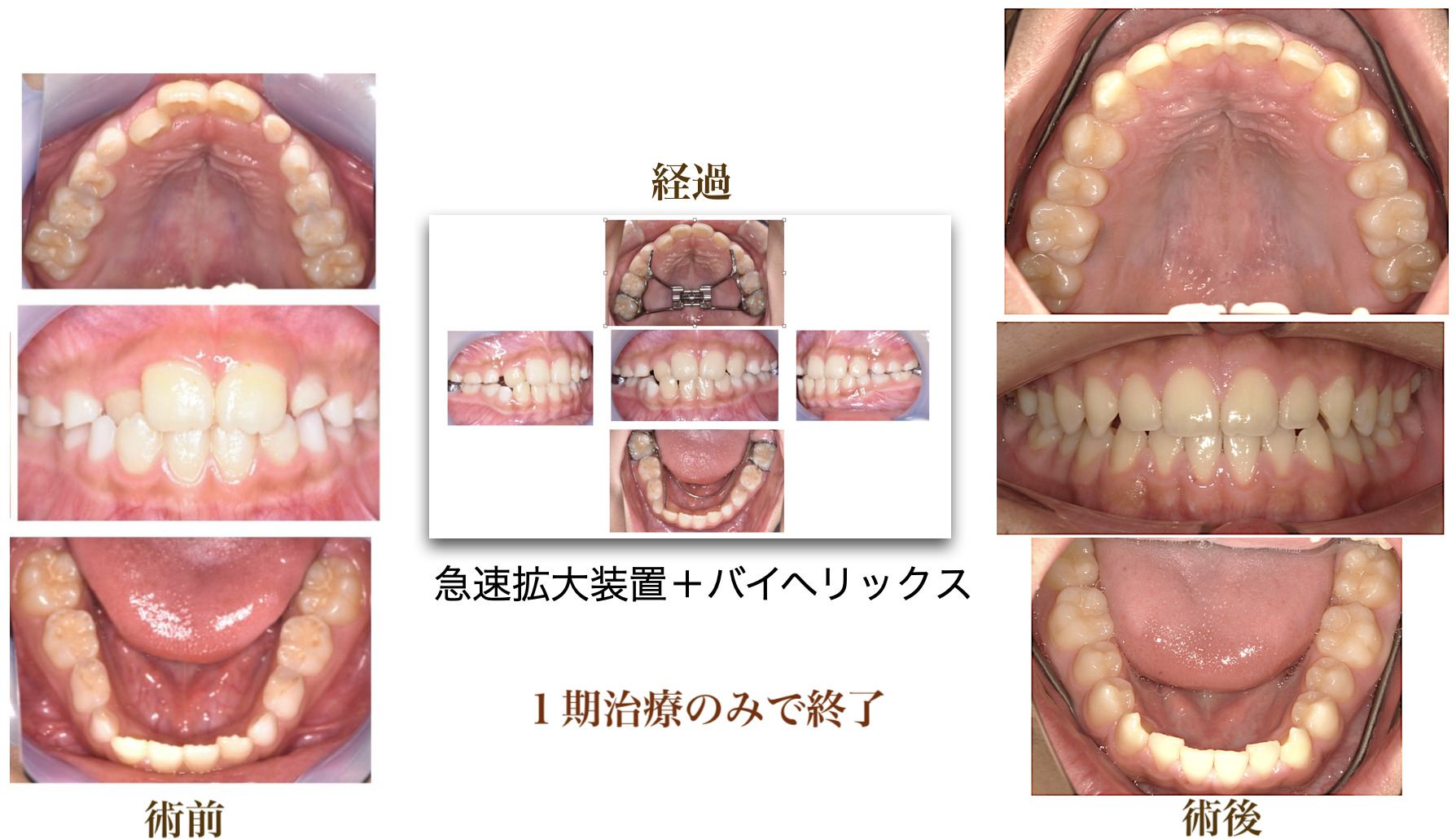 小児矯正治療の術前・経過・術後を並べた症例画像その1