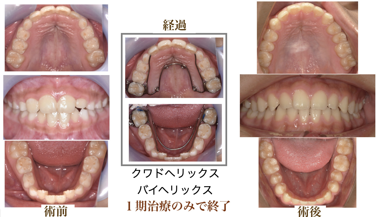 小児矯正治療の術前・経過・術後を並べた症例画像その2