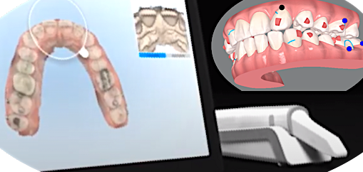 口腔内の光学3Dスキャン画像と歯並びのシミュレーション