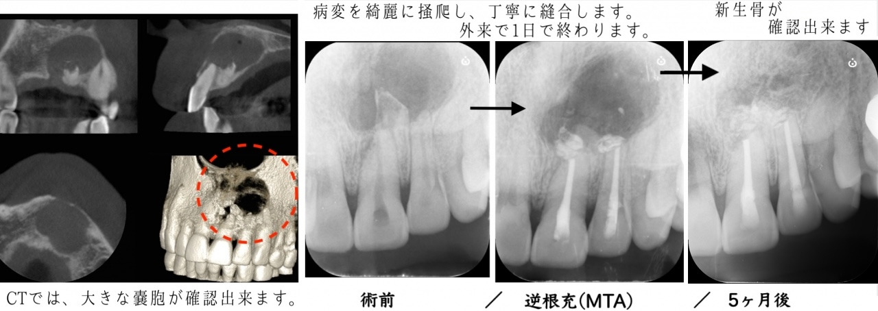 歯根嚢胞の治療例