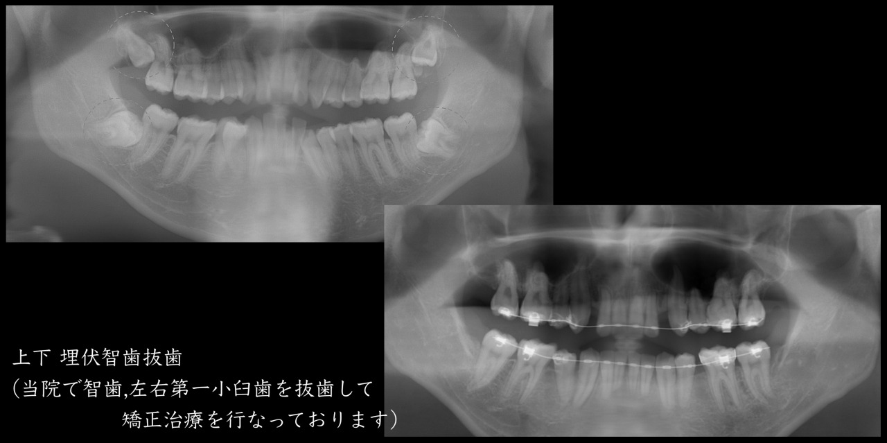 上下の埋伏智歯抜歯の治療例