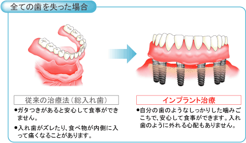 インプラント4