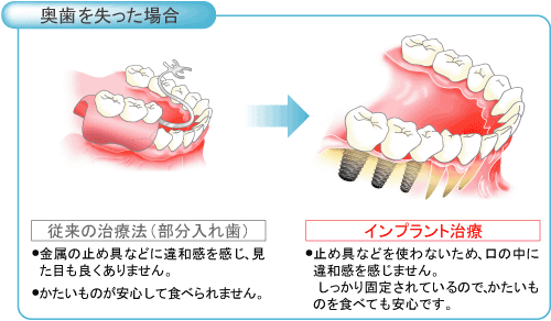 インプラント3