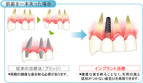 インプラント2