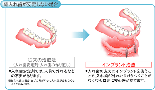 インプラント5